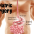Bariatric Surgery in Delhi India