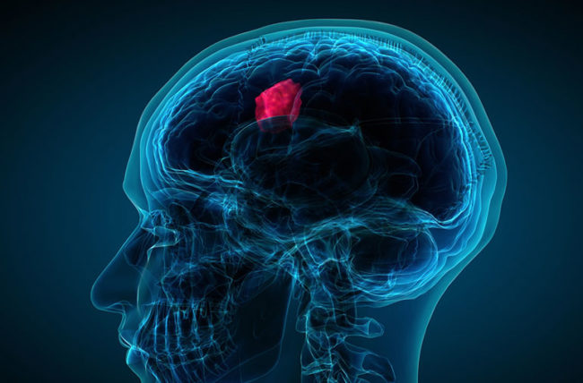 best hospital for brain tumor surgery in Delhi India