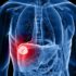 best liver cancer hospital in Delhi