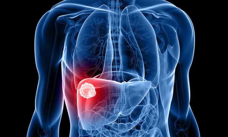 best liver cancer hospital in Delhi