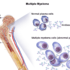 best hospital for treatment of multiple myeloma in india