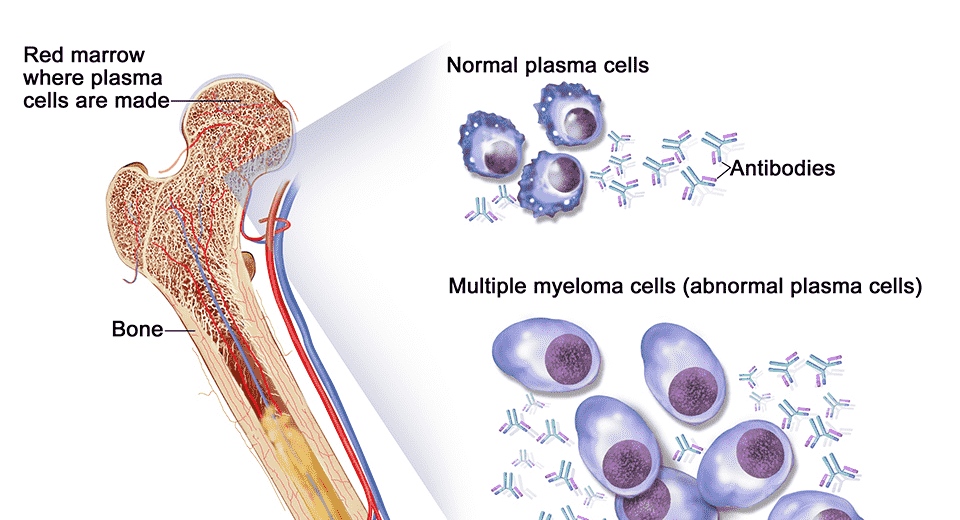 best hospital for treatment of multiple myeloma in india