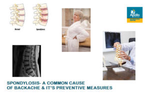 SPONDYLOSIS- A COMMON CAUSE OF BACKACHE & IT’S PREVENTIVE MEASURES