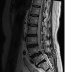Spondylosis spine