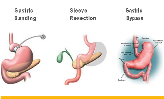 Verious Bariatric Surgery Types.png