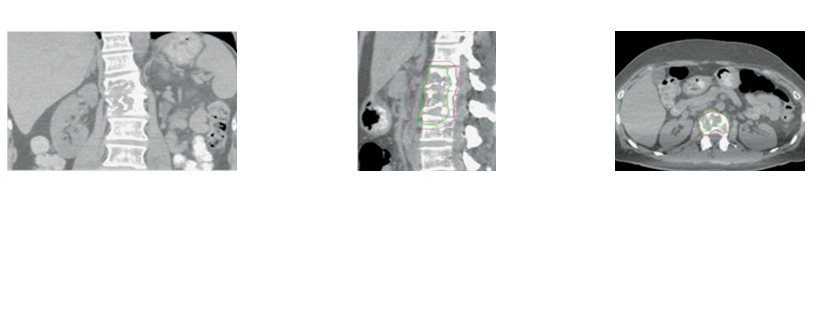 Apollo Speciality Cancer Hospital the patient underwent CyberKnife® method with 27Gy radiation dosage