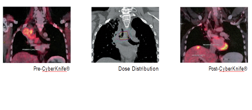 CyberKnife® PET scan showed good radiological response