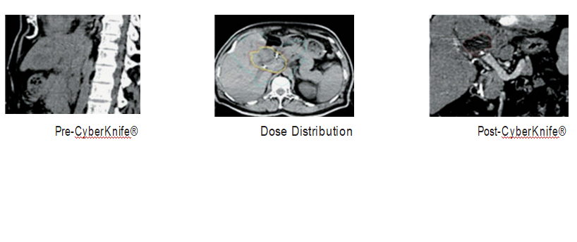 CyberKnife® for Inoperable Cholangiocarcinoma