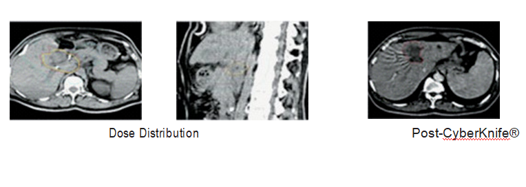 CyberKnife® radiosurgery