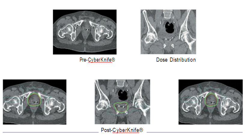 CyberKnife® treatment Prostate cancer Case Study