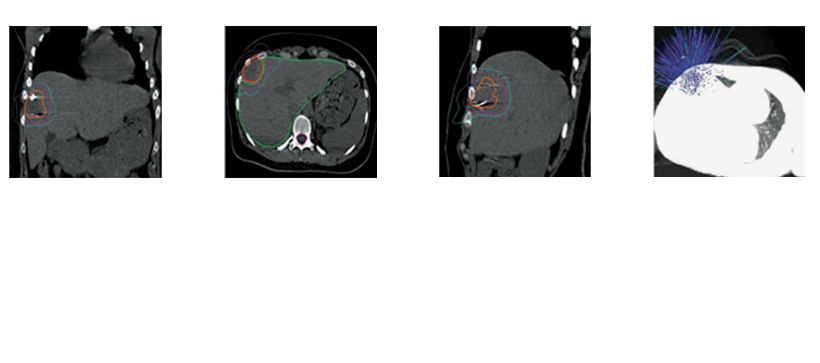 Follow-up examination performed after 3 months of CyberKnife® showed no obvious symptoms