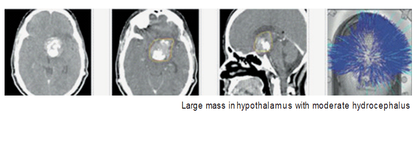 Large mass in hypothalamus with moderate hydrocephalus