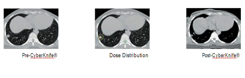 Radiation therapy or surgery is frequently advised
