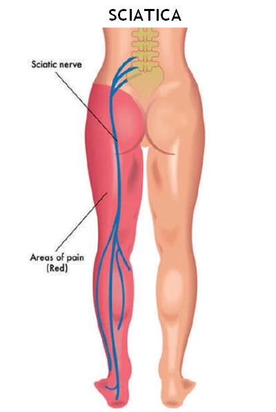 pain referred to as Sciatica  Claudication