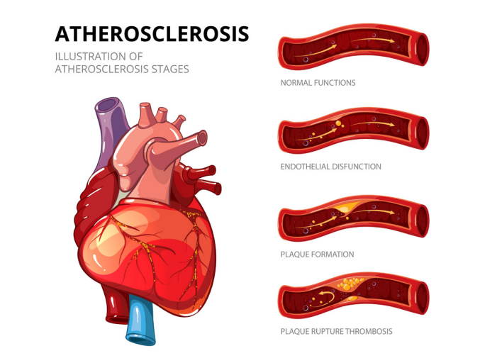 Progression of atherosclerosis