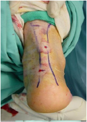 treated by TendoAchilles Lengthening 