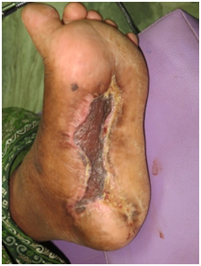 Life threatening infection Left Foot 