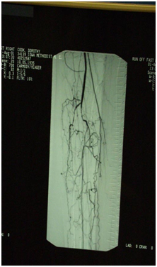 Fem-Tibial Bypass surgery to revascularise the limb