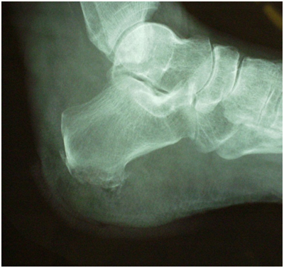 Clinically the wound probed directly to calcaneus and Xray changes
