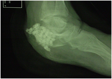 non-healing left foot ulcer