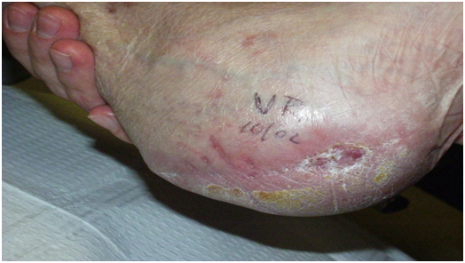 non-healing left foot ulcer