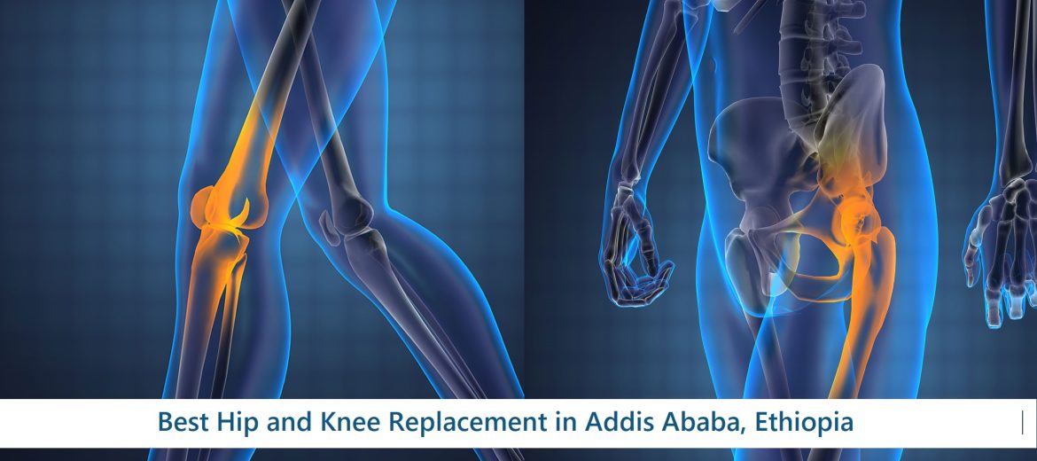 Best Hip and Knee Replacement in Addis Ababa, Ethiopia