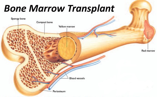 Best-Bone-Marrow-Transplant