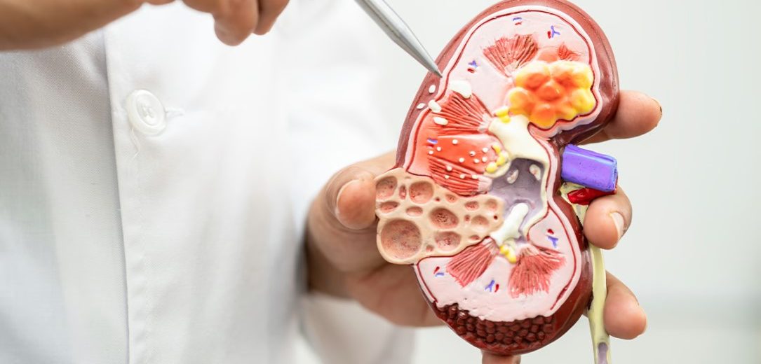 Top Kidney Transplant Treatment in India for Kenyan Patients