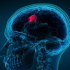 Brain Tumor Treatment in Kenya and Ethiopia